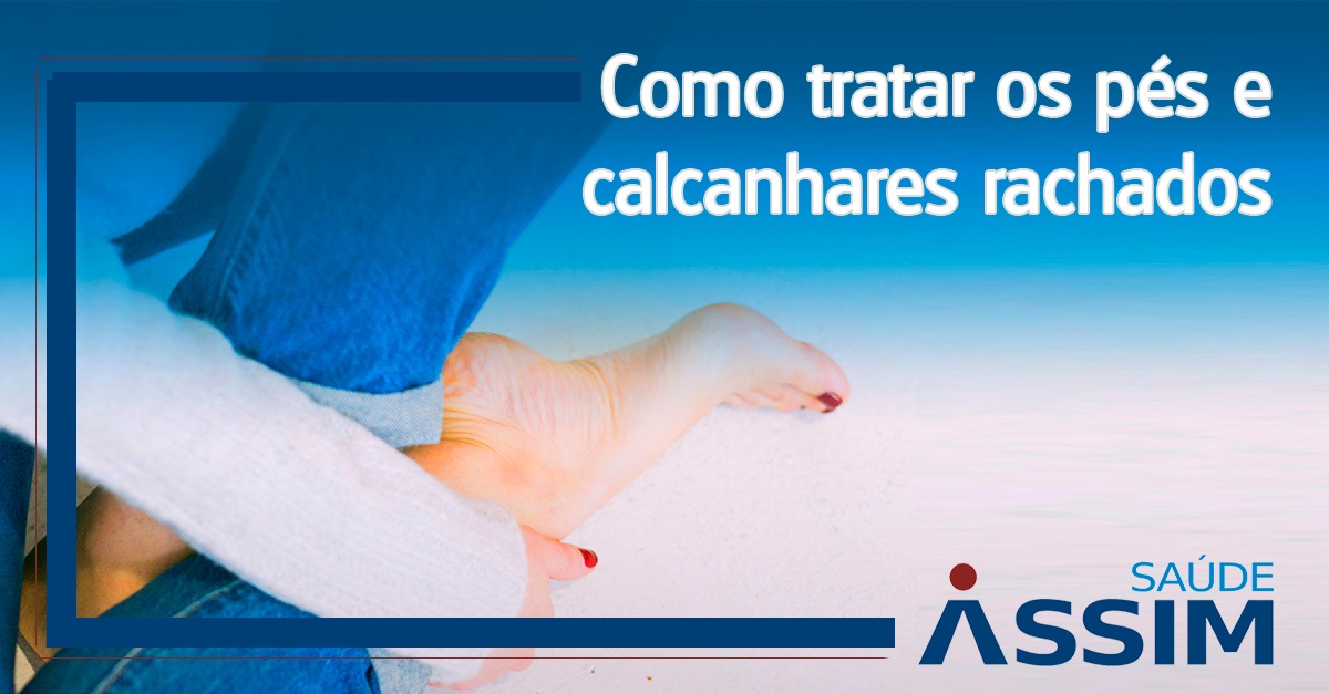 Como tratar os p�s e calcanhares rachados
